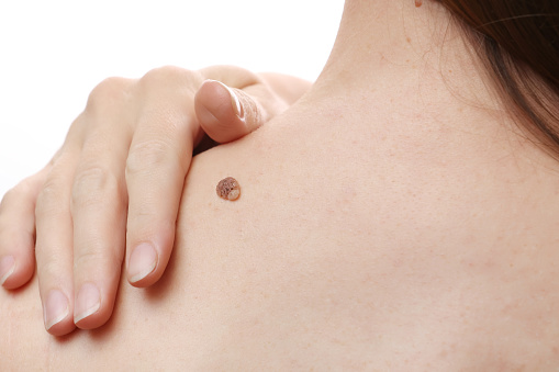 large nevus wart on young female shoulder, woman visiting doctor dermatologist, concept of benign neoplasms on human skin, regular examination and treatment.